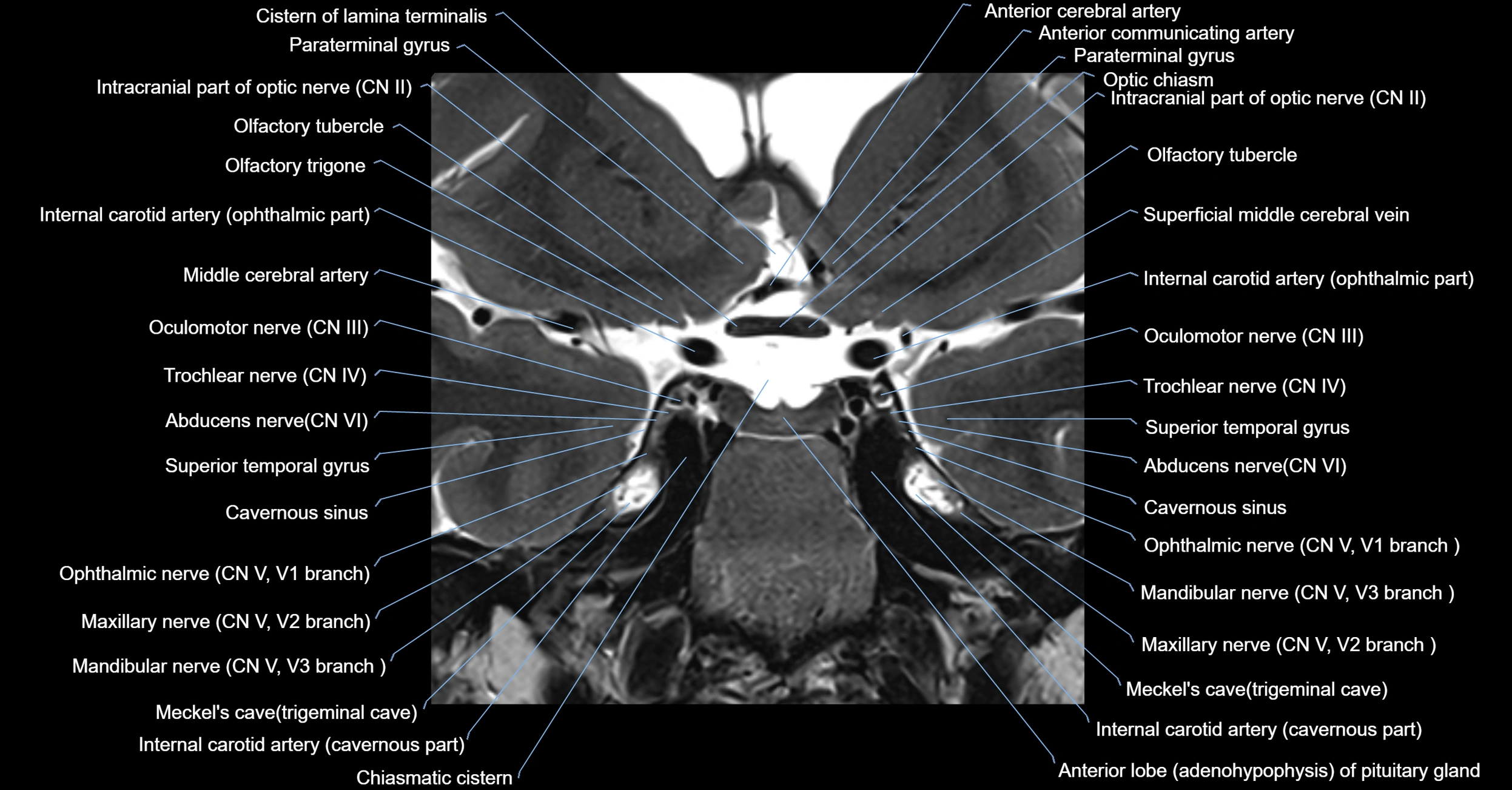 MRI cavernous sinus coronal cross sectional 3T anatomy image-img-00001-00011.webp